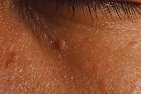 Mole Removal Complete Patient Guide